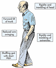 Parkinson's disease